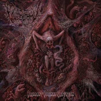 Album Vulvectomy: Aberrant Vaginal Gestation